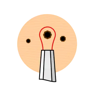 skin tag removal